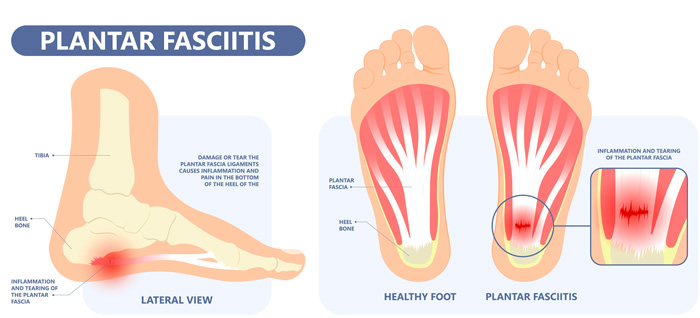 Fascia plantar sana vs fascitis plantar