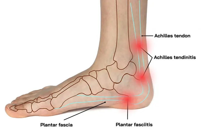 Zona de dolor de la Fascitis plantar vs tendinitis Aquilea