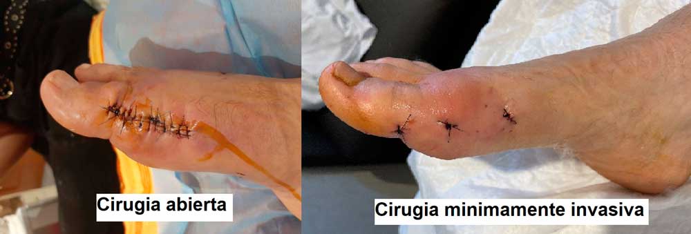 cirugía abierta vs mínimamente invasiva del hallux rígidus
