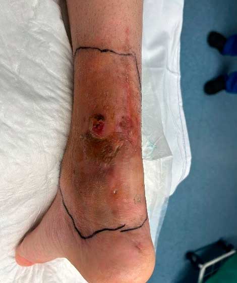Tratamiento con cirugía abierta de una rotura del tendón de Aquiles Tratamiento con cirugía abierta de una rotura del tendón de Aquiles. La infección es uno de los riesgos posibles de esta opción quirúrgica