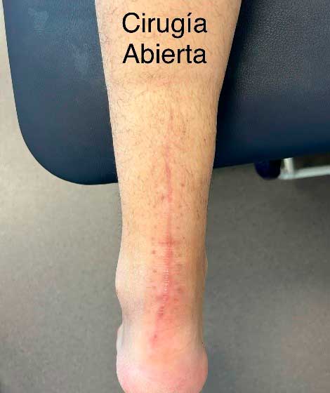 1rt pruebas de diagnóstico de la tendinosis o paratendinosis Aquilea