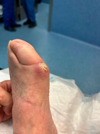 Bunión de la deformidad de los dedos de los pies provocada por los juanetes