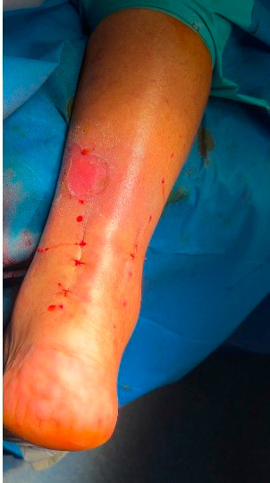 Reparación del tendón de Aquiles por caída en moto Reparación del tendón de Aquiles por caída en moto
