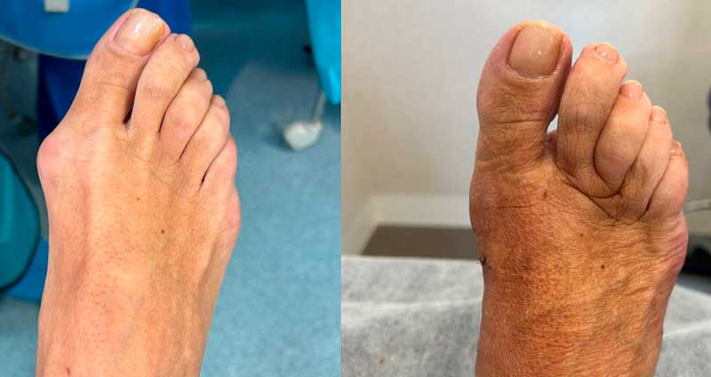 Testimonios de pacientes operados de hallux valgus por uno de los pocos profesionales especializados cirugía mínimamente invasiva de esta deformidad