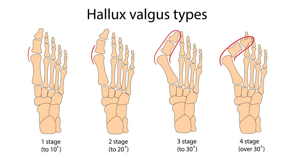 etapas y tipos de Hallux valgus. Grados de desviación o deformidad según el estadio o evolución.<br />