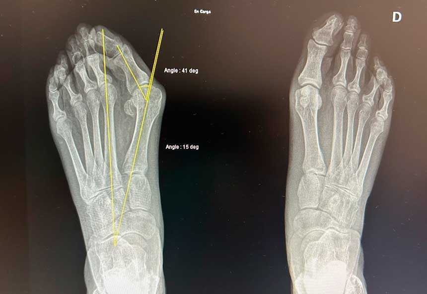 radiografía de paciente con hallux valgus tipo severo