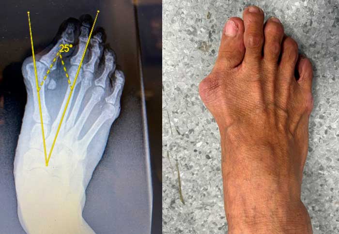 imagen radiológica vs real de paciente con hallux valgus o juanete con deformidad grave de los dedos