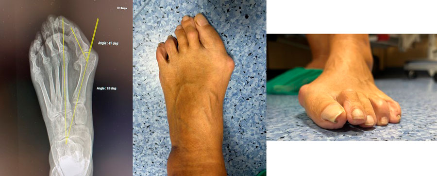 radiografía e imágen real de paciente con deformidad de dedos por hallux abductus valgus
