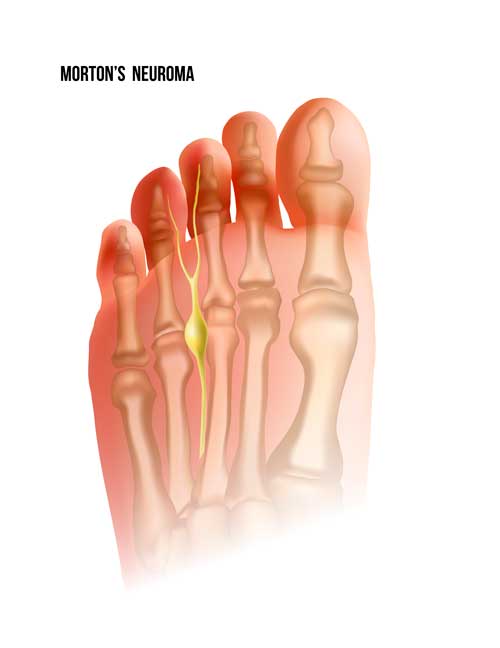 Neuroma de morton tratamientos y cirugía avanzados y mínimamente invasivos