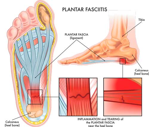 Estructura de la fascia plantar e imágen indicando dónde se localiza la inflamación o rotura de la fascia plantar