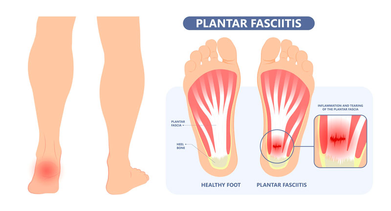 Fascitis Plantar. ¿Qué es? Causas, Síntomas y Diagnóstico