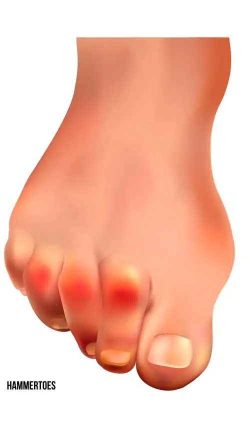 Dedos en garra con enrojecimiento y puntos de presión en el pie