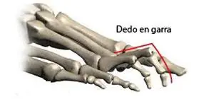 Dedo en garra con afectación ósea y articular del pie