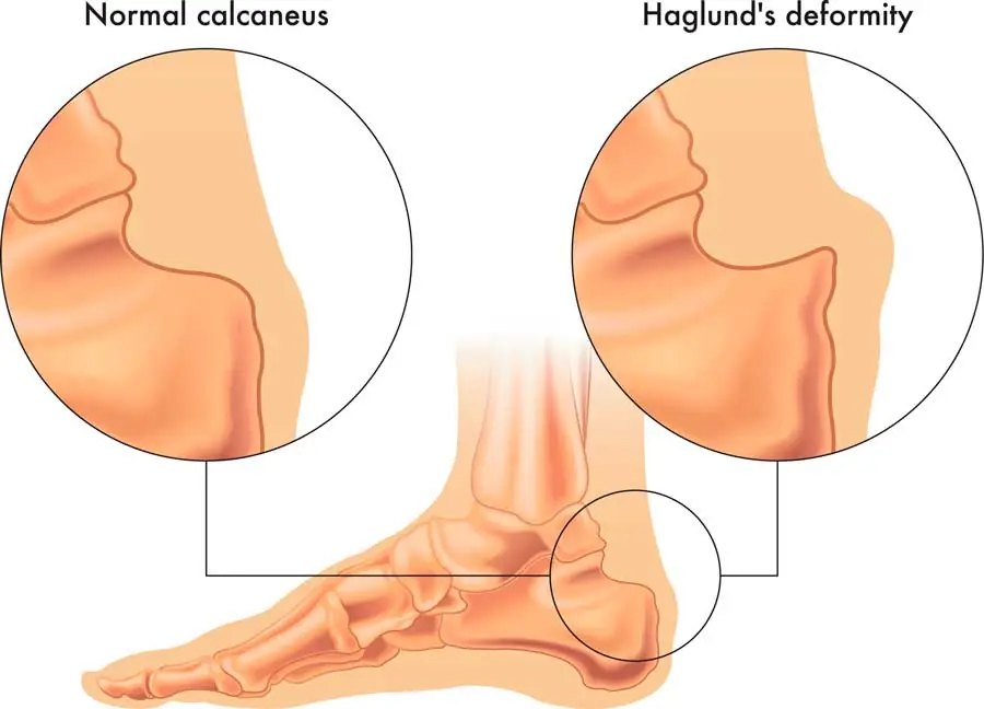 El hueso calcáneo normal vs su deformidad que provoca la enfermedad o deformidad de Haglund
