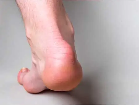 Tratamiento con cirugía ecoguiada mínimamente invasiva de la enfermedad o deformidad de Haglud