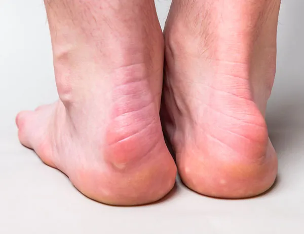 Las prominencias óseas en el talón son uno de los síntomas más caraterísticos de la enfermedad de Haglund