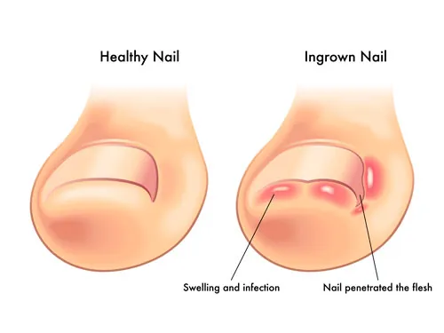 Factores congénitos vs desencadenantes de la onicocriptosis