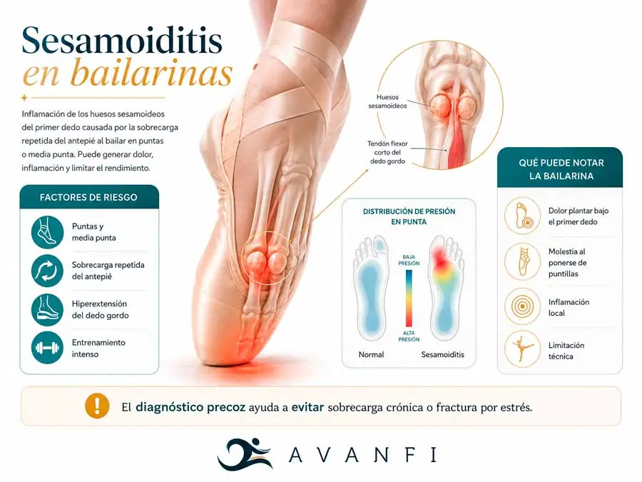 las sesamoiditis son frecuentes en bailarinas. Te explicamos los factores de riesgo de la mano del Dr. Iborra