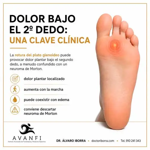 Clínica de la rotura del plato glenoideo que se manifiesta con dolor bajo el 2º o 3er dedo