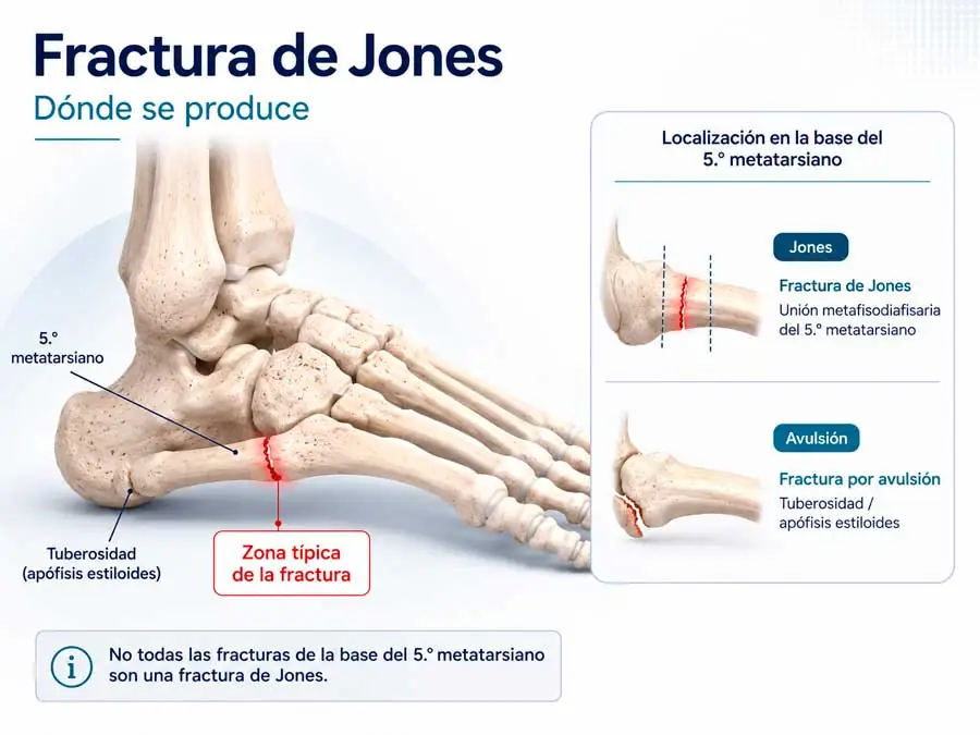 Dónde se produce la fractura de Jones