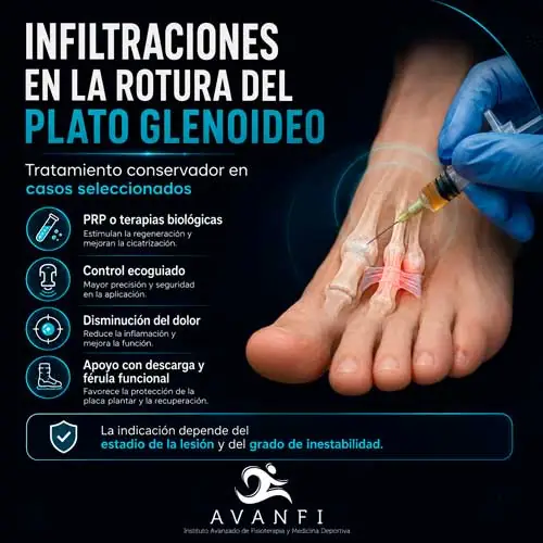Principalmente el dolor se produce en una fase inicial de rotura del plato glenoideo, asociado a edema en el dorso del antepié.