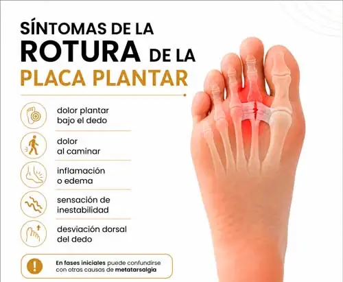 Síntomas de la rotura de la placa plantar