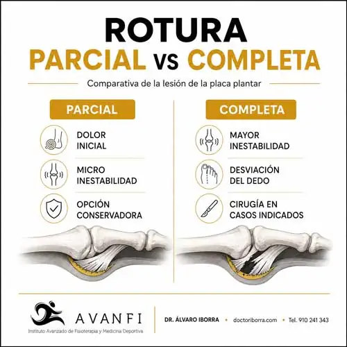 rotura parcial vs rotura total del plato glenoideo