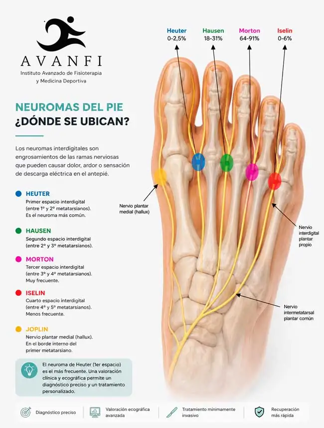 Esquema anatómico de los nervios digitales plantares del pie comparando la localización del neuroma de Morton y el neuroma de Heuter y otros neuromas de los dedos de los pies
