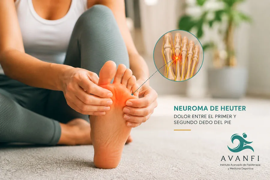 El neuroma de Heuter es un engrosamiento del nervio digital plantar propio del cuarto espacio interdigital del pie. Vista de la planta del pie mostrando el cuarto espacio interdigital donde se localiza el neuroma de Heuter. 
