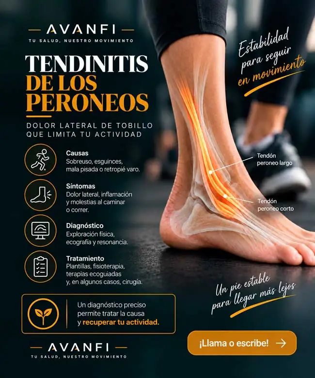 Tendinitis de los peroneos: causas, síntomas y diagnóstico Infografía de tendinitis de los peroneos con anatomía lateral del tobillo, síntomas, diagnóstico y tratamiento