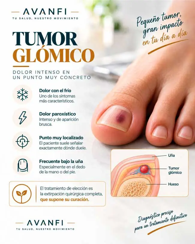 Infografía sobre tumor glómico con dolor localizado, sensibilidad al frío y localización bajo la uña